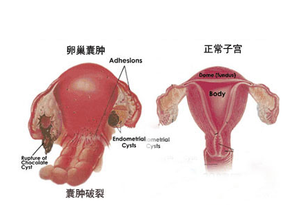当卵巢囊肿撞上怀孕