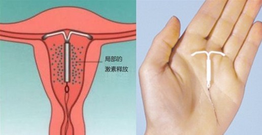 上海哪家医院取放环比较好？