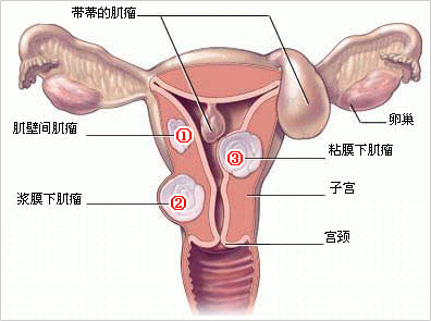 子宫肌瘤的病因