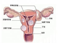 ＂健康保卫战＂ 腹腔镜微创技术巧治妇科杂症
