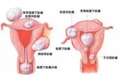我院专家团队强强联手 成功剔除13厘米子宫肌瘤