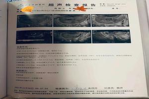 阿图什引产多久复查(5个月引产完多久能上班) 阿图什引产多久复查(5个月引产完多久能上班)