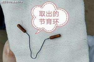 永康上环环结扎哪个好(结扎好还是上环比较好)