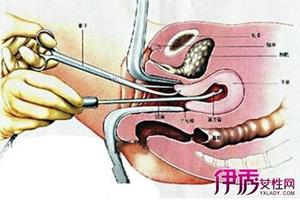 阿图什引产后要清宫吗(引产后清宫要多少分钟) 阿图什引产后要清宫吗(引产后清宫要多少分钟)