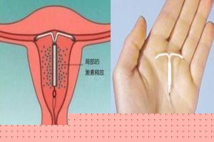 永康上环很痛吗(女性上环到底有多痛)