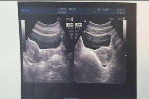 阿图什做引产疼吗(三个月做无痛引产疼吗) 阿图什做引产疼吗(三个月做无痛引产疼吗)