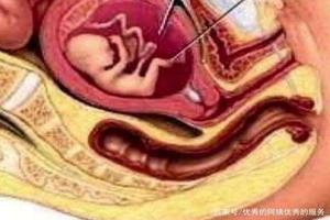 阿图什引产需要刮宫吗(为什么引产要清宫顺产就不用清宫) 阿图什引产需要刮宫吗(为什么引产要清宫顺产就不用清宫)