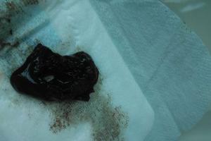 阿图什药流半个月同(70天的孕囊图片) 阿图什药流半个月同(70天的孕囊图片)