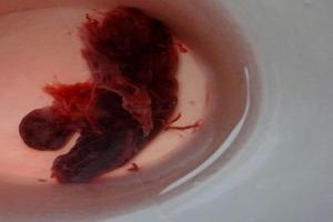 阿图什药流半个月(一个月流掉的孕囊图片) 阿图什药流半个月(一个月流掉的孕囊图片)