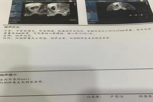 阿图什药流效果(吃堕胎药成功的几率大不大) 阿图什药流效果(吃堕胎药成功的几率大不大)