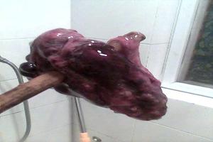 阿图什药流的图片(孕囊排出来的图片) 阿图什药流的图片(孕囊排出来的图片)