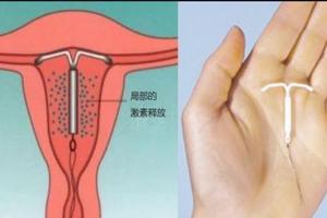 阿图什怎样上环(上环的方法) 阿图什怎样上环(上环的方法)